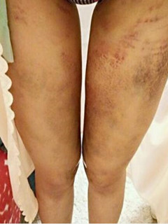 吸脂瘦大腿讓我變回纖纖細(xì)腿