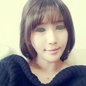 下頜角整形手術(shù)三個(gè)多月了，分享下我的恢復(fù)前后對(duì)比果圖片吧~