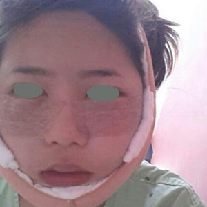 下頜角整形手術(shù)三個(gè)多月了，分享下我的恢復(fù)前后對(duì)比果圖片吧~