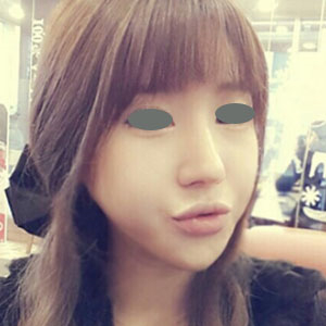 下頜角整形手術(shù)三個(gè)多月了，分享下我的恢復(fù)前后對(duì)比果圖片吧~