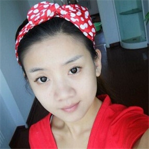 曬曬我做面部吸脂術(shù)前后對(duì)比果照片，中日友好高占巍做的哦~~