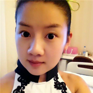 曬曬我做面部吸脂術(shù)前后對(duì)比果照片，中日友好高占巍做的哦~~