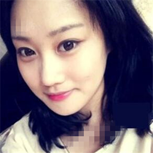 看看我磨下頜角整形手術(shù)恢復(fù)前后的對(duì)比圖片，同學(xué)都說我像張馨予~~