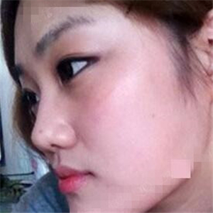 看看我磨下頜角整形手術(shù)恢復(fù)前后的對(duì)比圖片，同學(xué)都說我像張馨予~~