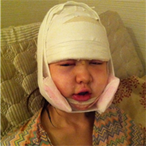 上海華美李志海做的v－line瓜子臉手術(shù)，果太好了~哈哈哈~