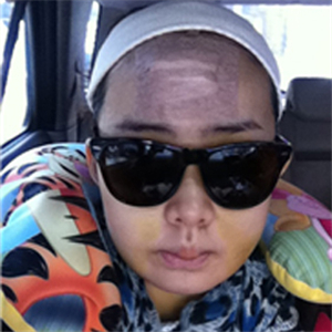 上海華美李志海做的v－line瓜子臉手術(shù)，果太好了~哈哈哈~