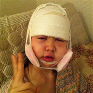 做了v－line瓜子臉手術(shù)八個月了，果很好，看看前后對比照片吧~