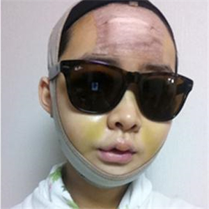 做了v－line瓜子臉手術(shù)八個月了，果很好，看看前后對比照片吧~