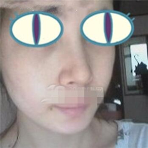 自體耳軟骨隆鼻手術恢復過程和前后對比圖分享，變化太大啦~~~