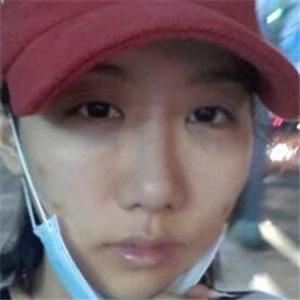 顴骨提高手術(shù)恢復(fù)前后的對(duì)比圖片分享，果很好的說(shuō)~