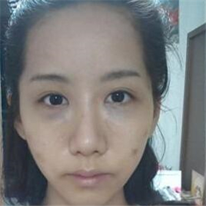 顴骨提高手術(shù)恢復(fù)前后的對(duì)比圖片分享，果很好的說(shuō)~