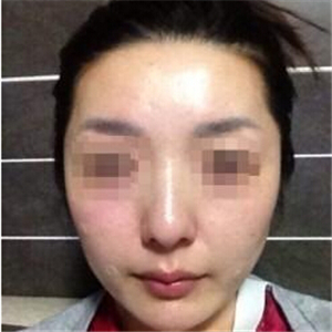 打B****告別大餅?zāi)槪謴?fù)前后的對(duì)比果照片給你們看看哦