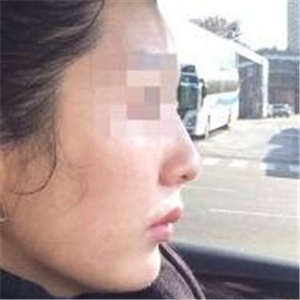 打B****告別大餅?zāi)?，恢?fù)前后的對(duì)比果照片給你們看看哦