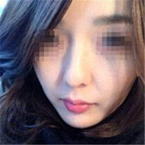 打B****告別大餅?zāi)?，恢?fù)前后的對(duì)比果照片給你們看看哦