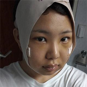 磨下頜角磨骨手術(shù)一個(gè)月了，分享一下恢復(fù)前后的果照片哇~