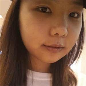 磨下頜角磨骨手術(shù)一個(gè)月了，分享一下恢復(fù)前后的果照片哇~