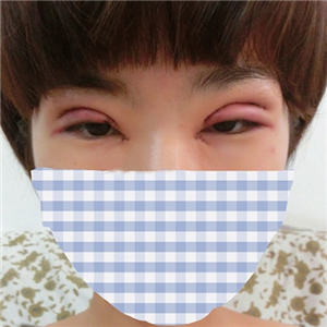 雙眼皮手術(shù)失敗修復(fù)一個(gè)月了，果不錯(cuò)，有前后對(duì)比果圖片哦~