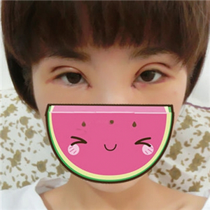 雙眼皮手術(shù)失敗修復(fù)一個(gè)月了，果不錯(cuò)，有前后對(duì)比果圖片哦~