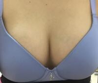 曼托假體豐胸價格恢復果圖