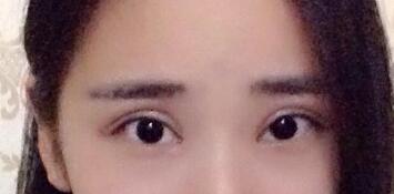 切開雙眼皮價格2680元，割雙眼皮拆線后圖片