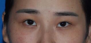 切開雙眼皮整形前圖片，價格2680元