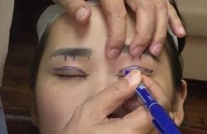 割雙眼皮術前圖片