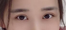 切開雙眼皮術后圖片