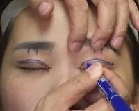 切開雙眼皮價格2680元，費用不貴果卻很好