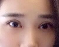 切開雙眼皮價格2680元，費用不貴果卻很好