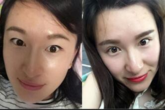 割雙眼皮前后對(duì)比圖