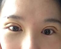 割雙眼皮過程恢復(fù)圖分享給大家，單眼皮變雙眼皮