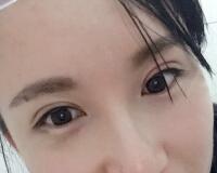 割雙眼皮過程恢復(fù)圖分享給大家，單眼皮變雙眼皮