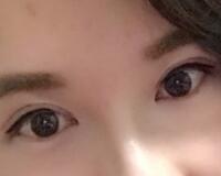 割雙眼皮過程恢復(fù)圖分享給大家，單眼皮變雙眼皮