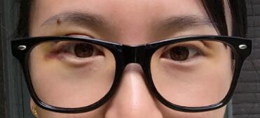 割雙眼皮恢復(fù)過(guò)程第五天