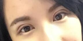 切開(kāi)雙眼皮拆線