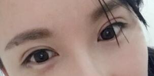 單眼皮切開(kāi)為雙雙眼皮術(shù)后圖片