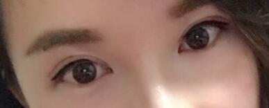 割雙眼皮過(guò)程恢復(fù)圖分享給大家，單眼皮變雙眼皮