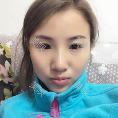 在惠州瑞芙臣做的隆鼻+玻尿酸隆下頜大家看看果怎么樣