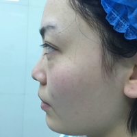 硅膠假體隆鼻后恢復(fù)得很漂亮下一步的目標(biāo)是自體脂肪全臉填充
