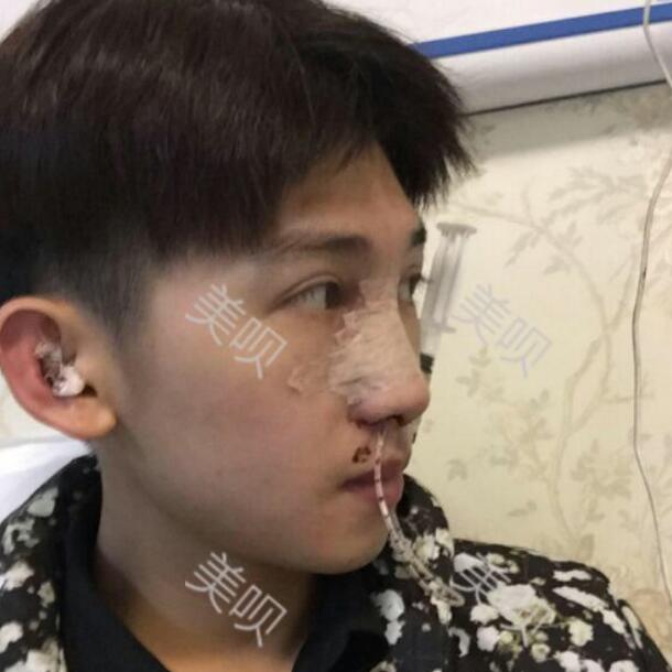給大家分享一下我的膨體隆鼻恢復過程我要變得更帥哦