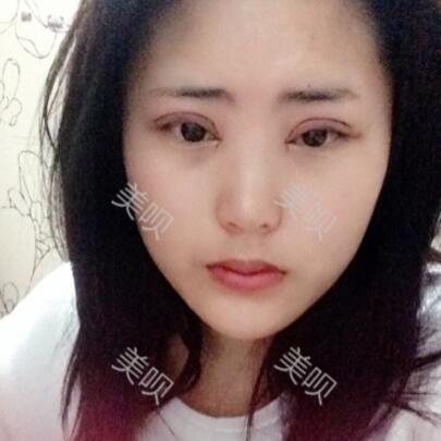 給大家看看我做的切開雙眼皮+開眼角恢復全過程很漂亮哦