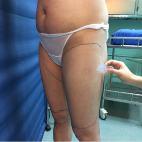 去年9月做的吸脂手術(shù)，大家來看看果怎么樣