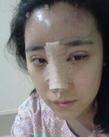 北京清木隆鼻+雙眼皮恢復日記