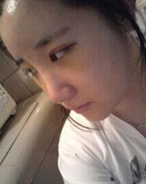 北京清木隆鼻+雙眼皮恢復日記