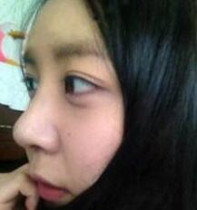 北京清木隆鼻整形后 **變身