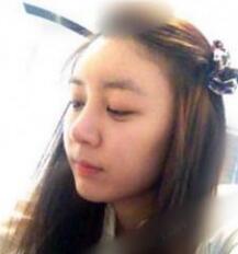 北京清木隆鼻整形后 **變身