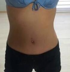 北京清木腰腹吸脂3個(gè)月感受