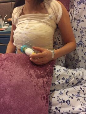 假體隆胸終于讓我擺脫了平胸妹的稱號(hào)，天津伊美爾熊斌做的