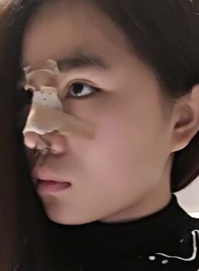 巨丑的鼻子做了隆鼻整形之后順眼多了