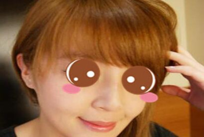 膨體隆鼻讓我的顏值更上一層